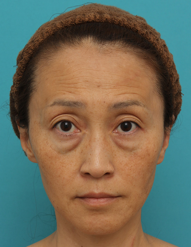 目の下の脂肪取り,40代女性の目の下をスッキリさせた症例写真,手術前,mainpic_shibo_under013a.jpg