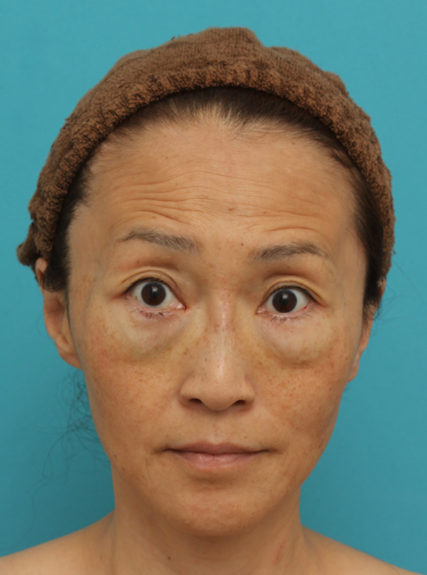 ゴルゴライン,40代女性の目の下をスッキリさせた症例写真,手術直後,mainpic_shibo_under013b.jpg