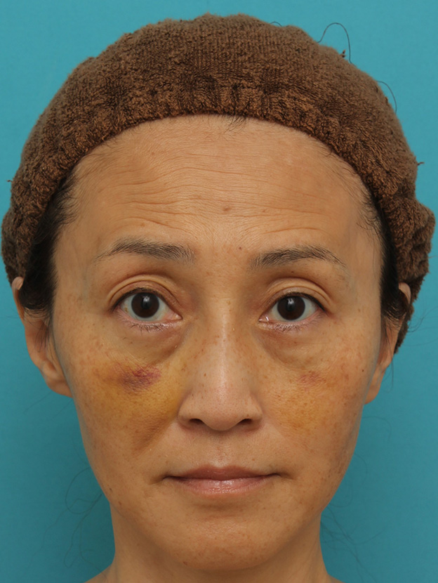 目の下の脂肪取り,40代女性の目の下をスッキリさせた症例写真,1週間後,mainpic_shibo_under013c.jpg