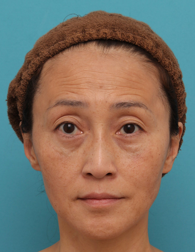 目の下の脂肪取り,40代女性の目の下をスッキリさせた症例写真,1ヶ月後,mainpic_shibo_under013d.jpg