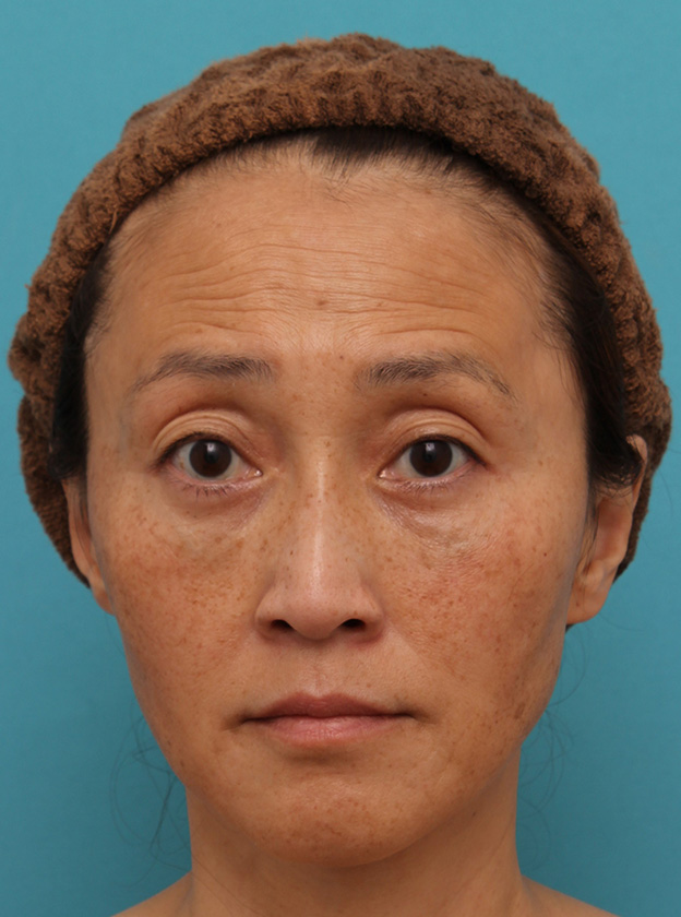 目の下の脂肪取り,40代女性の目の下をスッキリさせた症例写真,3ヶ月後,mainpic_shibo_under013e.jpg