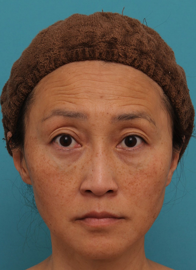 目の下の脂肪取り,40代女性の目の下をスッキリさせた症例写真,6ヶ月後,mainpic_shibo_under013f.jpg