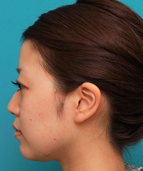小顔専用脂肪溶解注射メソシェイプフェイス,メソシェイプフェイス（顔専用の脂肪溶解注射）で小顔になった20代女性の症例写真,Before,ba_meso_face014_b02.jpg