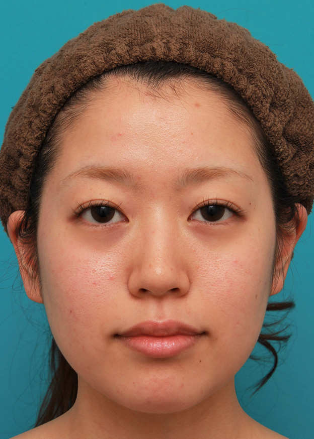 症例写真,メソシェイプフェイス（顔専用の脂肪溶解注射）で小顔になった20代女性の症例写真,1回目注射後,mainpic_meso_face014c.jpg