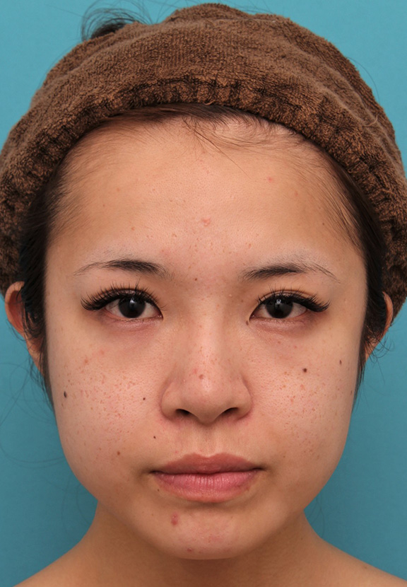 症例写真,上口唇にヒアルロン酸注射をし、アヒル口っぽくして鼻の下が短く見えるようになった症例写真,Before,ba_atsuku017_b01.jpg