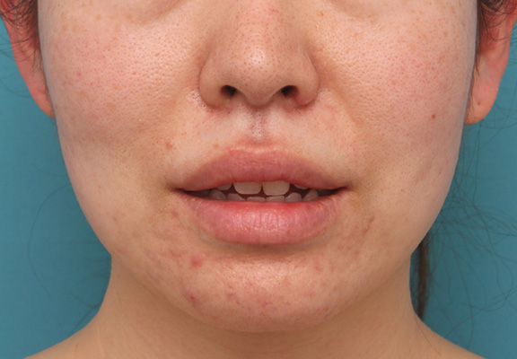 唇を薄く（口唇縮小術）,分厚い上下の唇を手術で薄くした症例写真,Before,ba_usuku012_b02.jpg