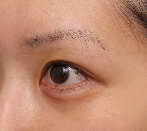 症例写真,ヒアルロン酸注射でやや大きめな涙袋を作った症例写真,After（8ヶ月後）,ba_namida015_b02.jpg