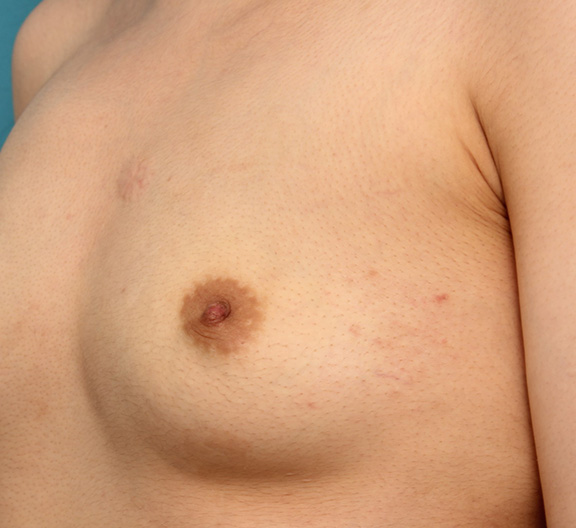 陥没乳頭,20代女性のやや重度の陥没乳頭を手術で治した症例写真,After（1ヶ月後）,ba_kanbotsu005_b02.jpg