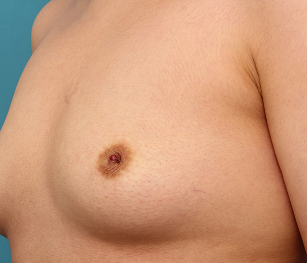陥没乳頭,20代女性のやや重度の陥没乳頭を手術で治した症例写真,手術直後,mainpic_kanbotsu005f.jpg