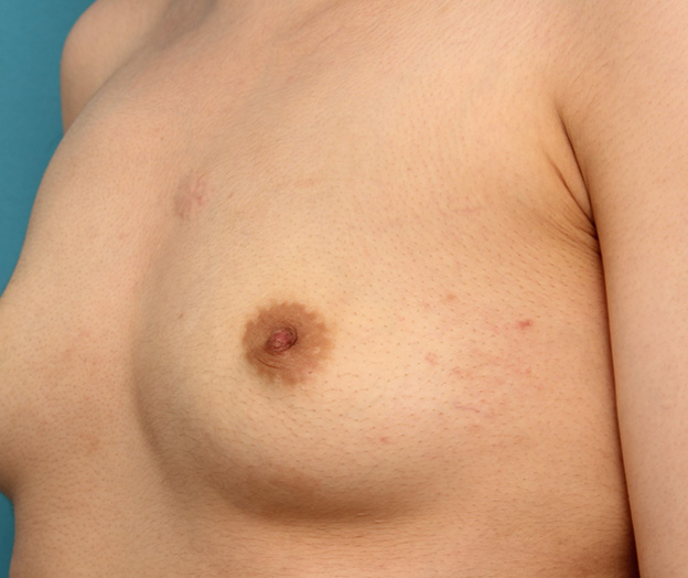 陥没乳頭,20代女性のやや重度の陥没乳頭を手術で治した症例写真,1ヶ月後,mainpic_kanbotsu005h.jpg