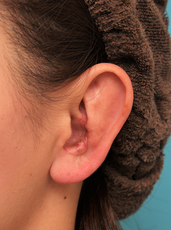症例写真,柔道耳（レッスルイヤー、カリフラワー耳）の手術の症例写真,After（1ヶ月後）,ba_judomimi001_b01.jpg