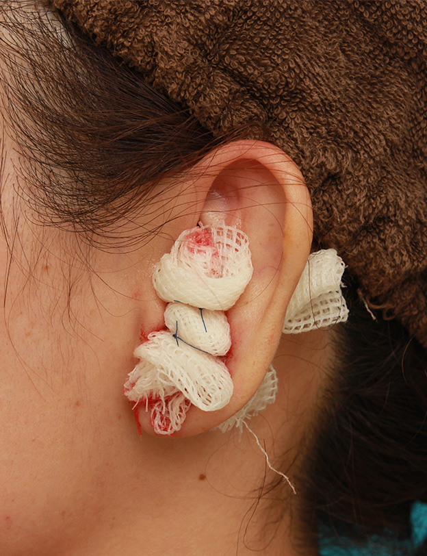 柔道耳,柔道耳（レッスルイヤー、カリフラワー耳）の手術の症例写真,手術直後,mainpic_judomimi001b.jpg