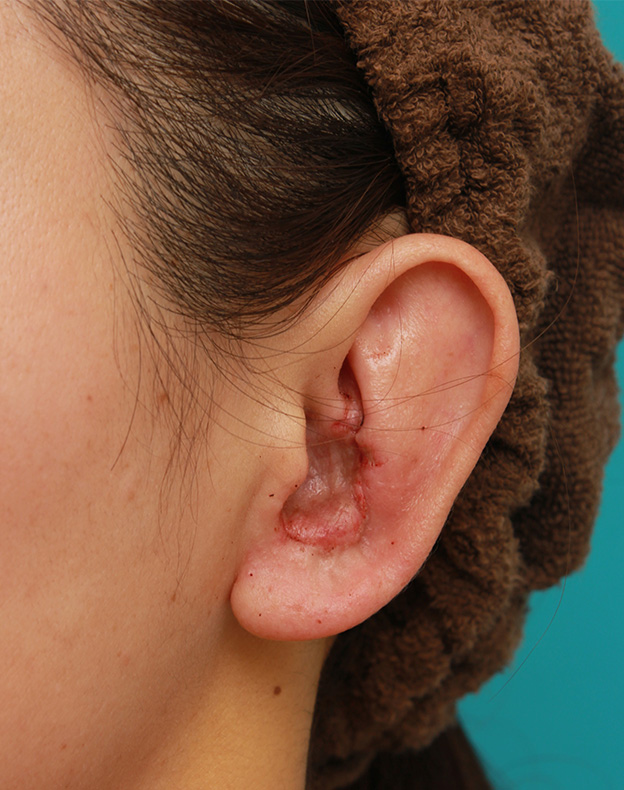 症例写真,柔道耳（レッスルイヤー、カリフラワー耳）の手術の症例写真,1週間後,mainpic_judomimi001c.jpg
