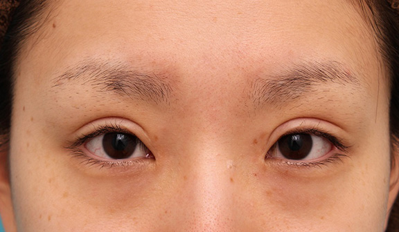 目頭切開,患者様の希望で幅広平行型二重を眼瞼下垂手術で作り、同時に目頭切開と目尻切開を行った症例写真,After（6ヶ月後）,ba_ganken039_b01.jpg