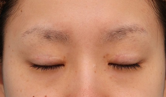 眼瞼下垂（がんけんかすい）,患者様の希望で幅広平行型二重を眼瞼下垂手術で作り、同時に目頭切開と目尻切開を行った症例写真,After（6ヶ月後の目を閉じた状態）,