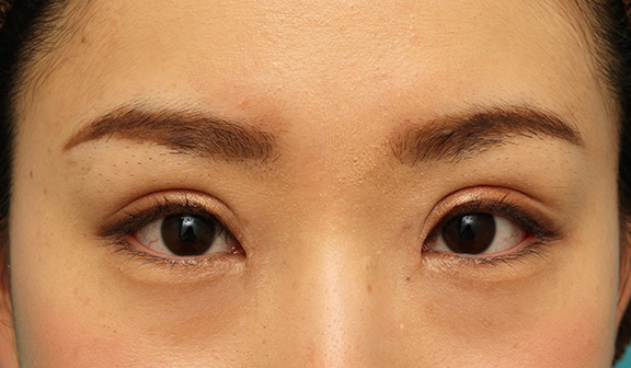 症例写真,患者様の希望で幅広平行型二重を眼瞼下垂手術で作り、同時に目頭切開と目尻切開を行った症例写真,After（6ヶ月後のメイクあり）,