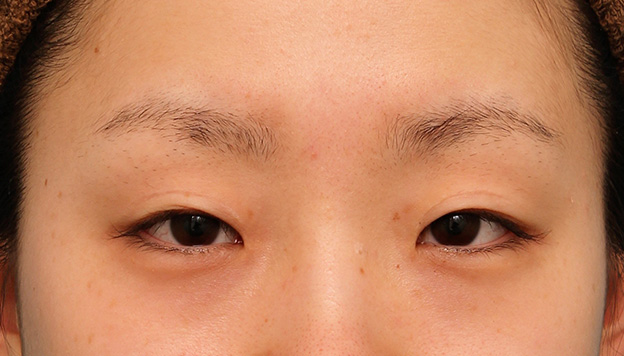 眼瞼下垂（がんけんかすい）,患者様の希望で幅広平行型二重を眼瞼下垂手術で作り、同時に目頭切開と目尻切開を行った症例写真,手術前,mainpic_ganken039a.jpg