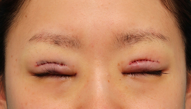 眼瞼下垂（がんけんかすい）,患者様の希望で幅広平行型二重を眼瞼下垂手術で作り、同時に目頭切開と目尻切開を行った症例写真,手術直後,目を閉じた状態,mainpic_ganken039c.jpg