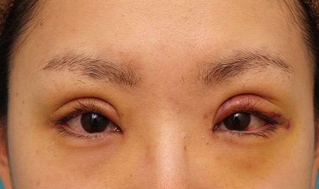 目尻切開,患者様の希望で幅広平行型二重を眼瞼下垂手術で作り、同時に目頭切開と目尻切開を行った症例写真,6日後,目を開けた状態,mainpic_ganken039d.jpg