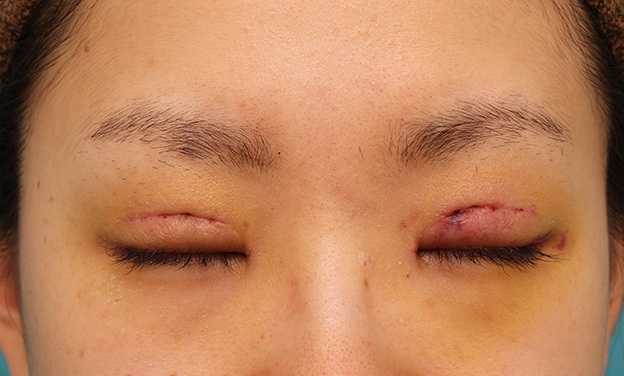 眼瞼下垂（がんけんかすい）,患者様の希望で幅広平行型二重を眼瞼下垂手術で作り、同時に目頭切開と目尻切開を行った症例写真,6日後,目を閉じた状態,mainpic_ganken039e.jpg