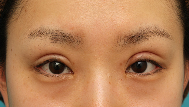 眼瞼下垂（がんけんかすい）,患者様の希望で幅広平行型二重を眼瞼下垂手術で作り、同時に目頭切開と目尻切開を行った症例写真,3週間後,目を開けた状態,mainpic_ganken039f.jpg