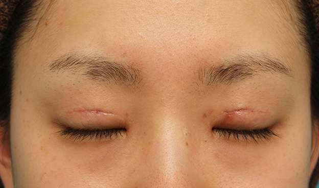 眼瞼下垂（がんけんかすい）,患者様の希望で幅広平行型二重を眼瞼下垂手術で作り、同時に目頭切開と目尻切開を行った症例写真,3週間後,目を閉じた状態,mainpic_ganken039g.jpg