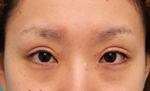 眼瞼下垂（がんけんかすい）,患者様の希望で幅広平行型二重を眼瞼下垂手術で作り、同時に目頭切開と目尻切開を行った症例写真,6ヶ月後,目を開けた状態,mainpic_ganken039h.jpg
