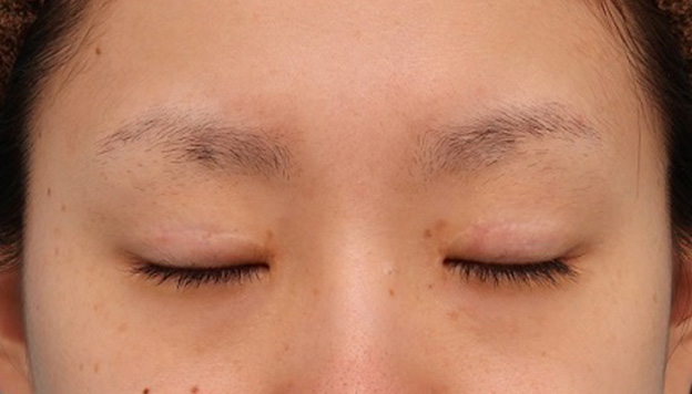 眼瞼下垂（がんけんかすい）,患者様の希望で幅広平行型二重を眼瞼下垂手術で作り、同時に目頭切開と目尻切開を行った症例写真,6ヶ月後,目を閉じた状態,mainpic_ganken039i.jpg