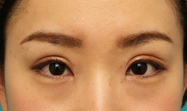 眼瞼下垂（がんけんかすい）,患者様の希望で幅広平行型二重を眼瞼下垂手術で作り、同時に目頭切開と目尻切開を行った症例写真,6ヶ月後,メイクあり,mainpic_ganken039j.jpg