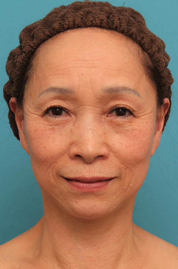 フェイスリフトで頬、フェイスライン、首のたるみをリフトアップさせた70代女性の症例写真,After（6ヶ月後）,ba_facelift005_a01.jpg