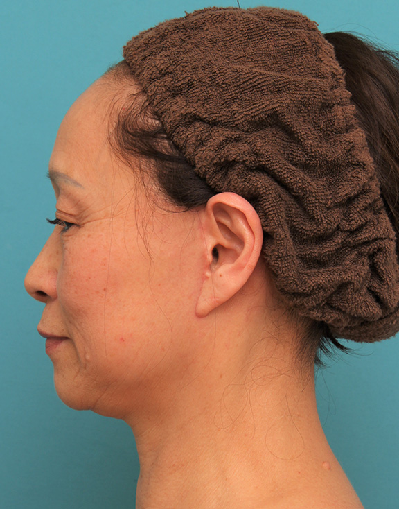 フルフェイスリフト,フェイスリフトで頬、フェイスライン、首のたるみをリフトアップさせた70代女性の症例写真,After（6ヶ月後）,ba_facelift005_b03.jpg