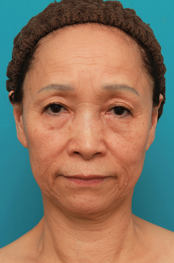フルフェイスリフト,フェイスリフトで頬、フェイスライン、首のたるみをリフトアップさせた70代女性の症例写真,Before,ba_facelift005_b01.jpg
