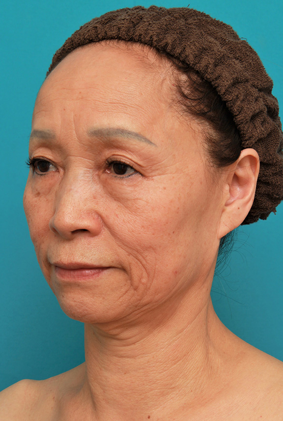 フルフェイスリフト,フェイスリフトで頬、フェイスライン、首のたるみをリフトアップさせた70代女性の症例写真,Before,ba_facelift005_b02.jpg