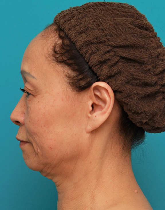 フルフェイスリフト,フェイスリフトで頬、フェイスライン、首のたるみをリフトアップさせた70代女性の症例写真,Before,ba_facelift005_b03.jpg