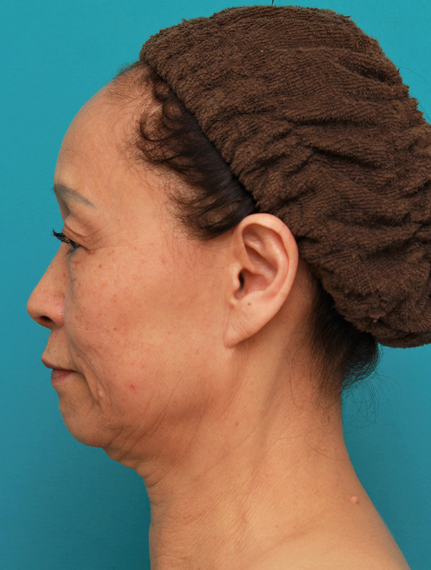 フルフェイスリフト,フェイスリフトで頬、フェイスライン、首のたるみをリフトアップさせた70代女性の症例写真,手術前,mainpic_facelift005f.jpg