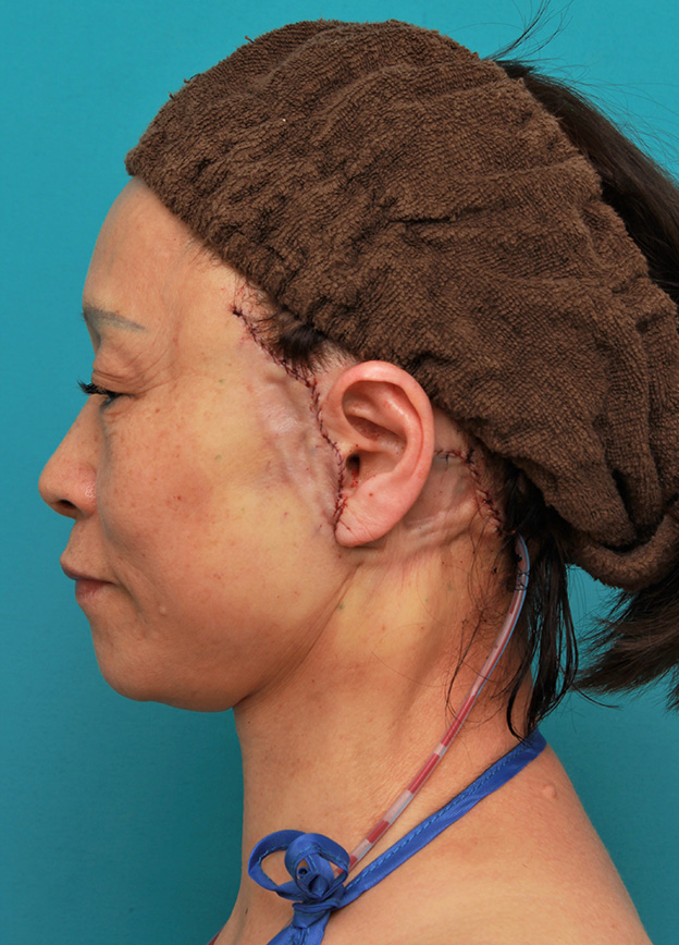 フルフェイスリフト,フェイスリフトで頬、フェイスライン、首のたるみをリフトアップさせた70代女性の症例写真,手術直後,mainpic_facelift005g.jpg