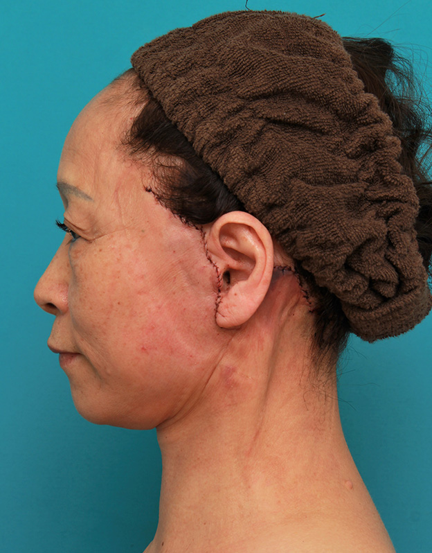 フルフェイスリフト,フェイスリフトで頬、フェイスライン、首のたるみをリフトアップさせた70代女性の症例写真,手術翌日,mainpic_facelift005h.jpg