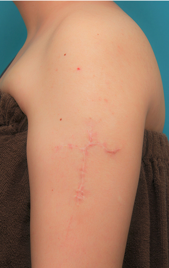 刺青（タトゥー）除去,肩に入っている十字架の入れ墨を1回で切除縫縮した20代女性の症例写真,After（2年後）,ba_irezumi034_b01.jpg