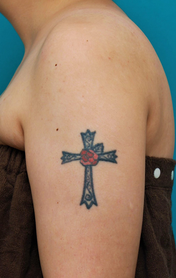 肩に入っている十字架の入れ墨を1回で切除縫縮した20代女性の症例写真,Before,ba_irezumi034_b01.jpg