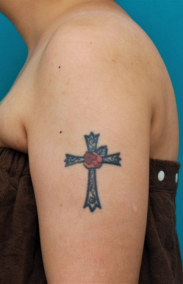 刺青（タトゥー）除去,肩に入っている十字架の入れ墨を1回で切除縫縮した20代女性の症例写真,手術前,mainpic_irezumi034a.jpg