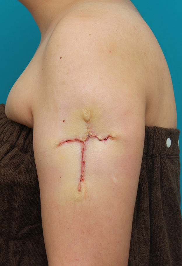 刺青（タトゥー）除去,肩に入っている十字架の入れ墨を1回で切除縫縮した20代女性の症例写真,手術直後,mainpic_irezumi034b.jpg