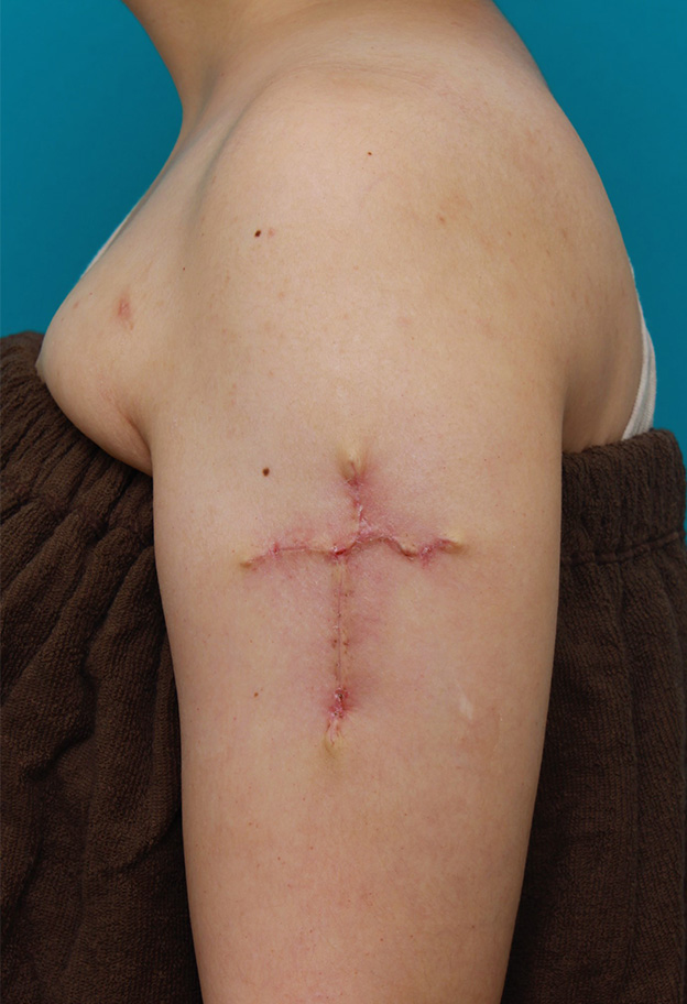 刺青（タトゥー）除去,肩に入っている十字架の入れ墨を1回で切除縫縮した20代女性の症例写真,1週間後,mainpic_irezumi034c.jpg