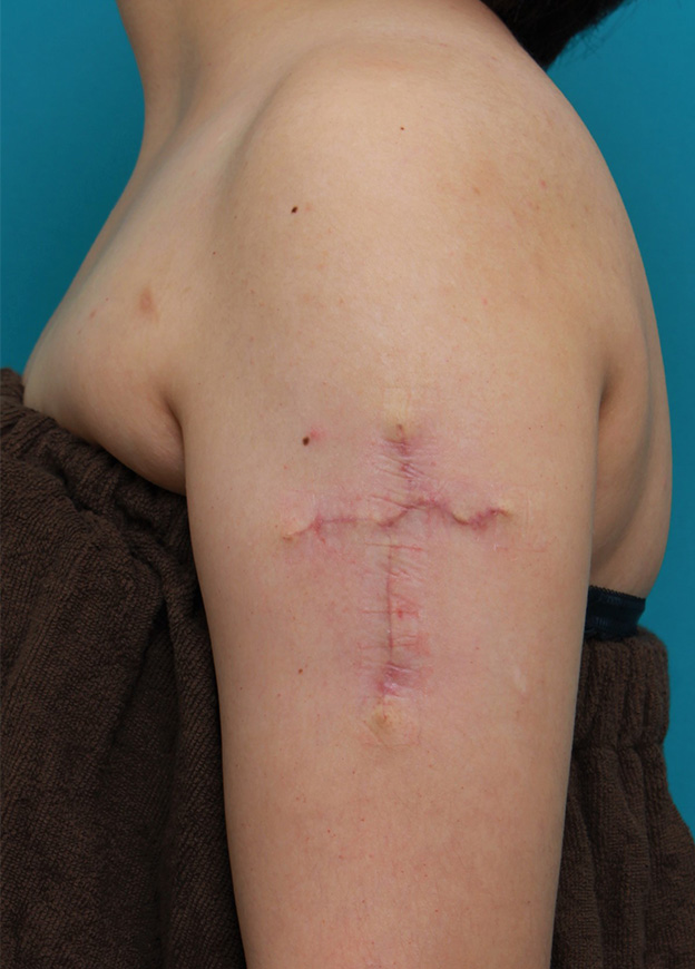 刺青（タトゥー）除去,肩に入っている十字架の入れ墨を1回で切除縫縮した20代女性の症例写真,1ヶ月後,mainpic_irezumi034d.jpg