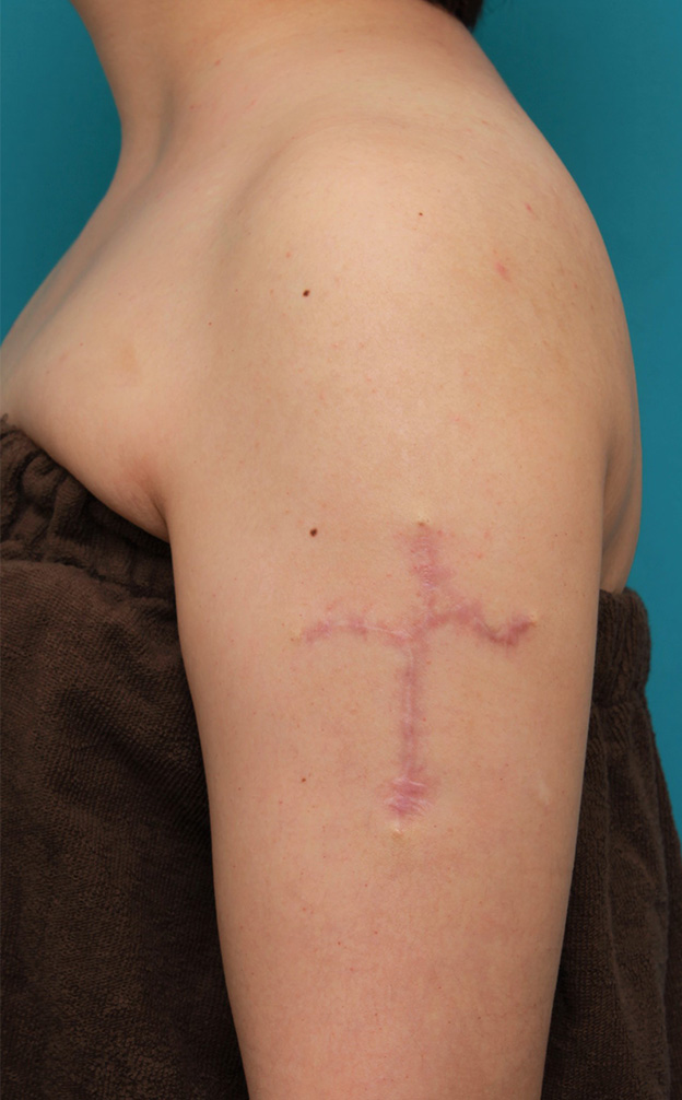 刺青（タトゥー）除去,肩に入っている十字架の入れ墨を1回で切除縫縮した20代女性の症例写真,6ヶ月後,mainpic_irezumi034f.jpg