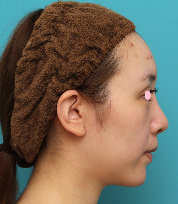 あご形成（シリコンプロテーゼ）,顎のシリコンプロテーゼで横顔のフェイスラインのバランスを整えた症例写真,After（6ヶ月後）,ba_ago018_b02.jpg