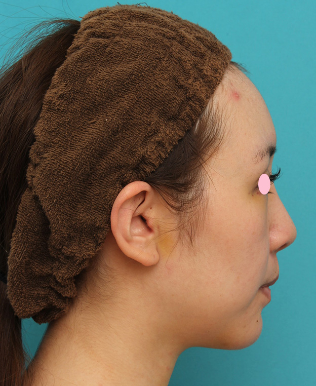 あご形成（シリコンプロテーゼ）,顎のシリコンプロテーゼで横顔のフェイスラインのバランスを整えた症例写真,1週間後,mainpic_ago018c.jpg