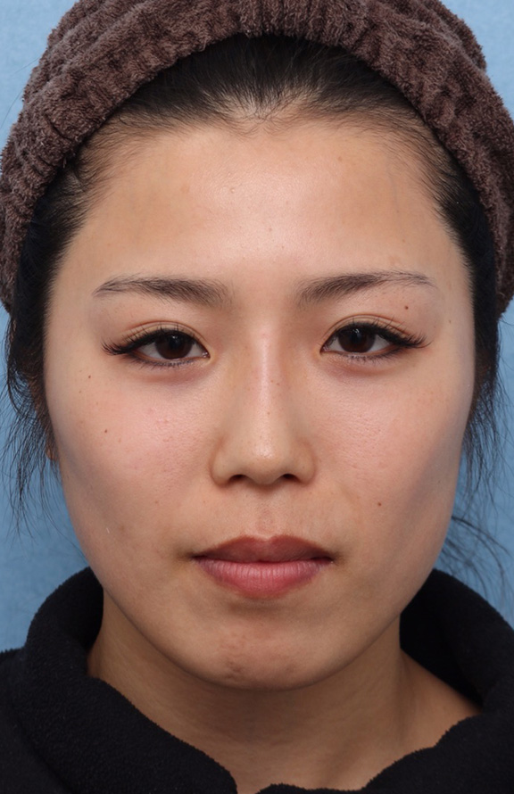 隆鼻注射（ヒアルロン酸注射）,隆鼻ヒアルロン酸の症例写真,After（1ヶ月後）,ba_ryubi2037_b01.jpg