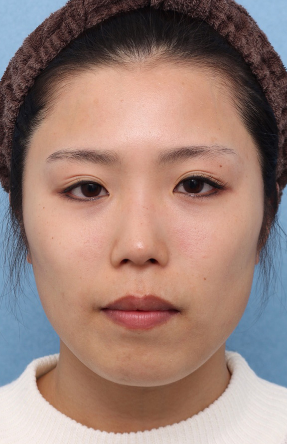 隆鼻注射（ヒアルロン酸注射）,隆鼻ヒアルロン酸の症例写真,Before,ba_ryubi2037_b01.jpg
