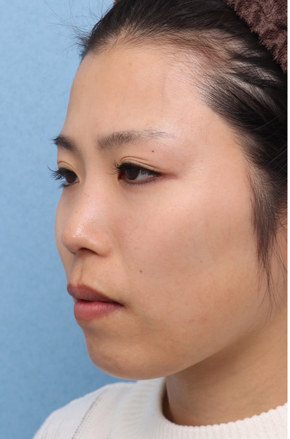 隆鼻注射（ヒアルロン酸注射）,隆鼻ヒアルロン酸の症例写真,Before,ba_ryubi2037_b02.jpg