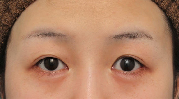 目尻切開,目尻切開で目を外側に広げた20代女性の症例写真,After（6ヶ月後）,ba_mejiri022_b01.jpg